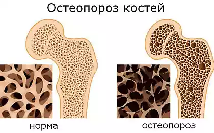 Остеопороз: Что нужно делать для его предотвращения