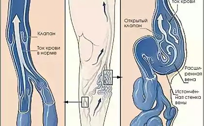 Варикозное расширение вен — психосоматика и лечение