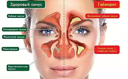 НАРОДНЫЕ МЕТОДЫ ЛЕЧЕНИЯ ГАЙМОРИТА.