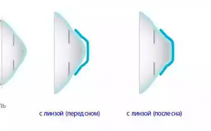 Ортокератология: годовой опыт использования ночных линз