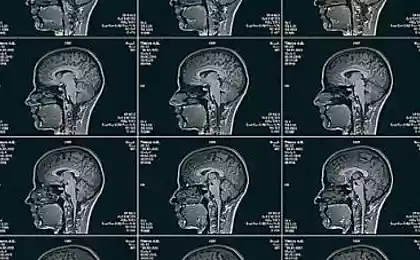 История о том, как учёные искали речь в голове журналиста