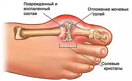 Вкусная профилактика подагры: как предотвратить заболевание суставов и спать спокойно