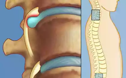 Узкий специалист: «Лечение межпозвоночной грыжи без лекарств, без операции! Нужно лишь упорно…»