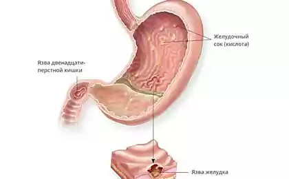 Лечение язвы желудка по методу Марвы Оганян