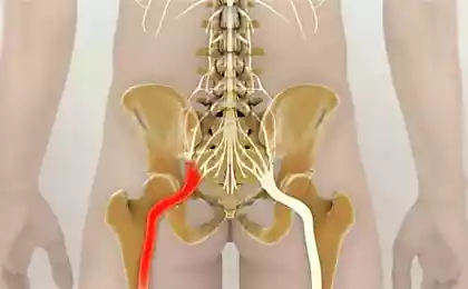 Хирурги, с уважением: «Защемление седалищного нерва не требует медикаментов! Успокоить воспаление помогут 2 простых…»