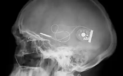 El pequeño de los implantes de DARPA en el sistema nervioso libran de la depresión sin medicamentos