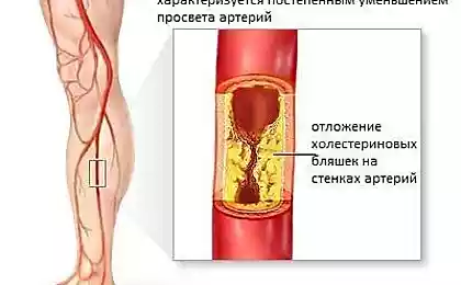 Атеросклероз сосудов ног: тревожные симптомы