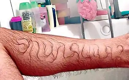 Эпиляция