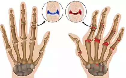 7 средств, которые успокоят симптомы артрита