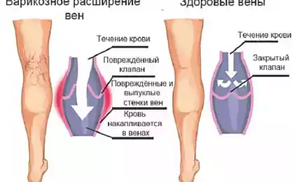 Чего боится варикоз: эффективные народные методы лечения