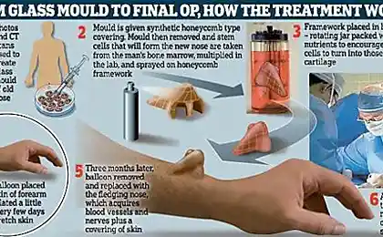 Врачи вырастили английскому бизнесмену нос на руке
