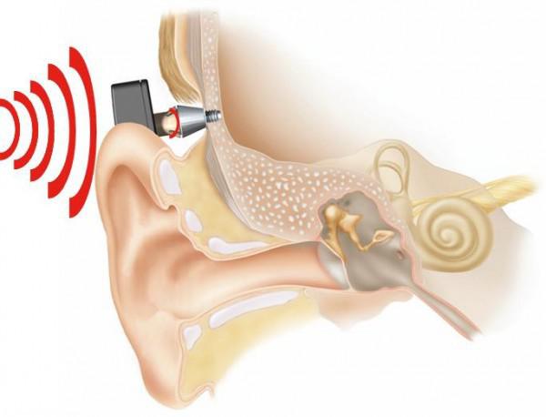 骨桥助听器植入图片