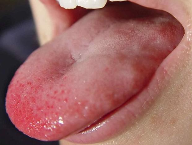 如果舌尖红没有疾病的存在这可能表明神经potryaseniya